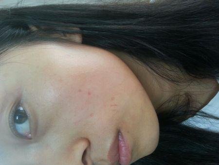 激光美白能维持多长时间？