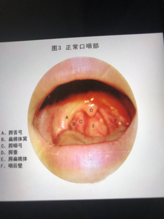 慢性咽炎怎么治疗才能彻底？