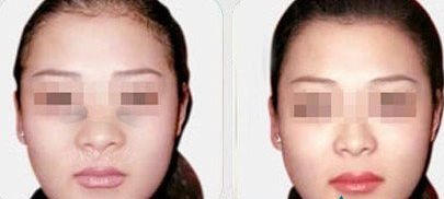 做鼻部整形需要多少钱？