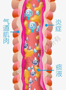 肺气肿是什么原因导致的