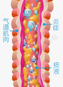 肺气肿是什么原因导致的