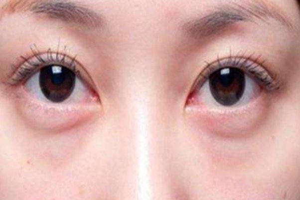 切除眼袋有什么坏处？