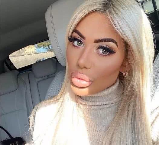 女星沉迷整容整成香肠嘴，整容前美艳动人，为何这么要想不开呢？