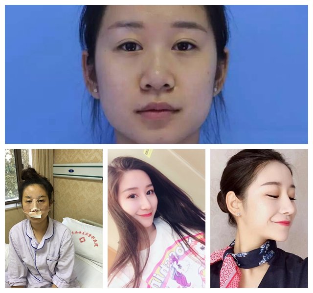 自体软骨隆鼻有哪些优点