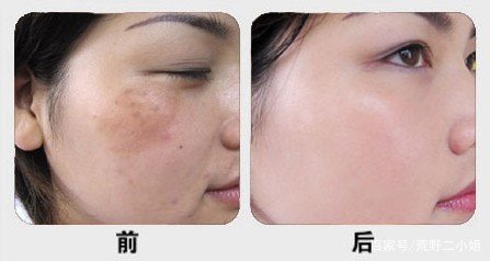 黄褐斑内调吃什么药?