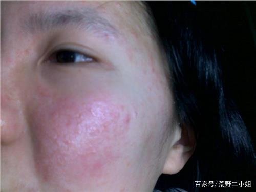 黄褐斑内调吃什么药?