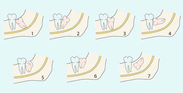 拔智齿的最佳时期?(急)