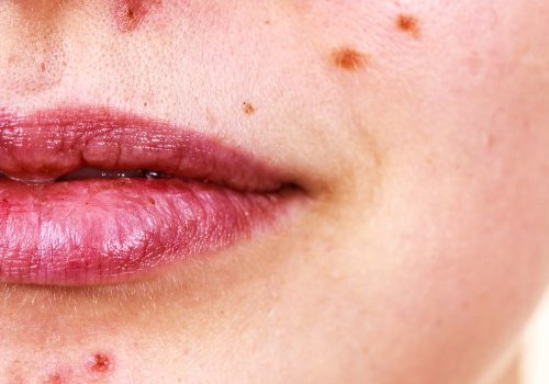 祛痘有哪些好方法