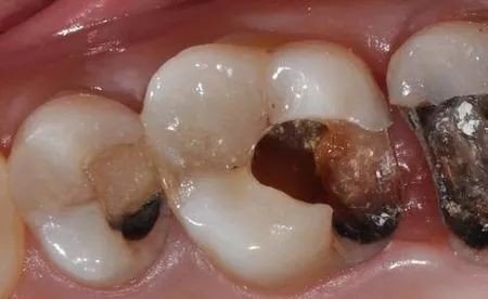 龋齿图片，