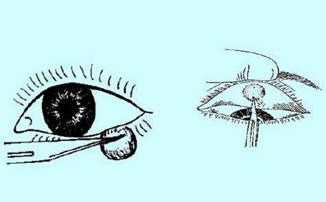 眼睛有玻璃体混浊该怎么办?