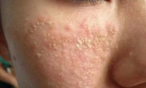 如何治疗面部脂溢性皮炎？