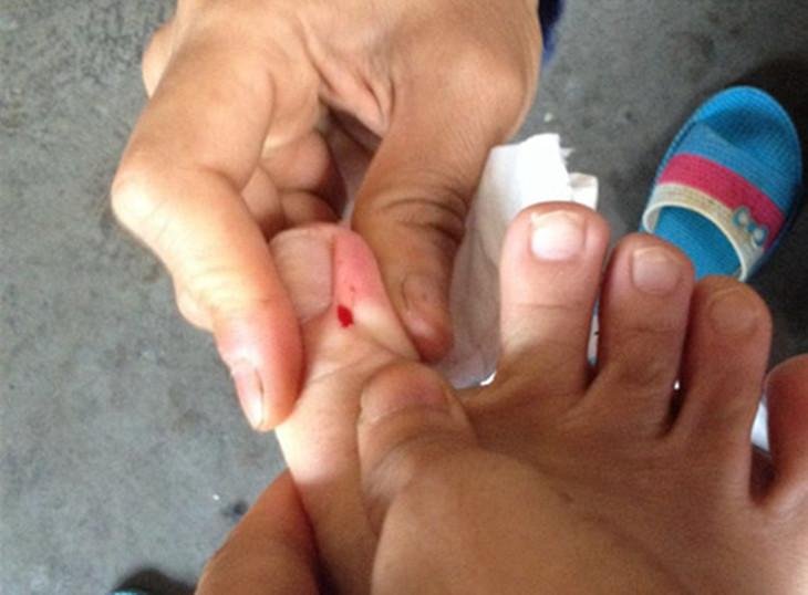 爷爷给2岁孙子针扎放血治抽搐，民间土方子有多危险？