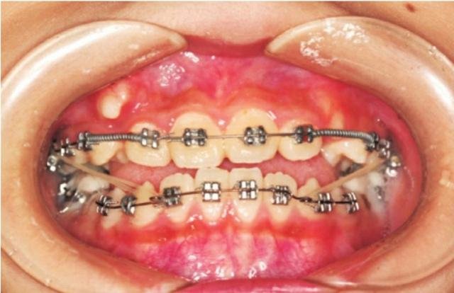 整牙有年龄限制吗?
