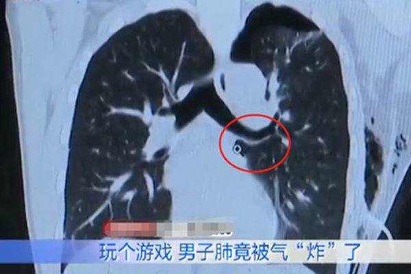 男子游戏连输肺气炸住院,连续配到坑队友的原因是什么?