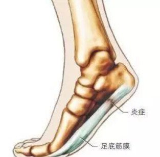 脚底板疼痛是怎么回事?