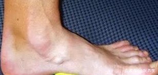 脚底板疼痛是怎么回事?