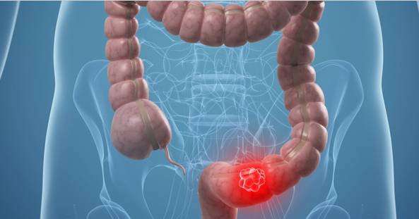 结肠癌是什么原因引起的?